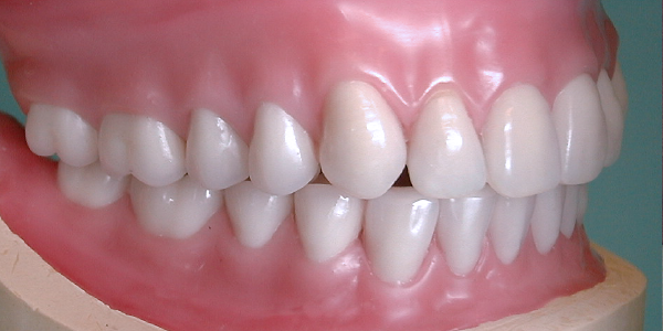 COMPLETE DENTURES | Foundation for Oral-facial Rehabilitation