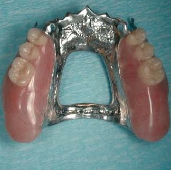 how to design removable partial denture in rotated abutment removable partial denture design