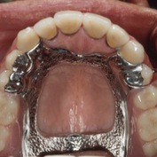 Removable Partial Dentures Surveyed Crown Combined Fixed Rpd S Foundation For Oral Facial Rehabilitation