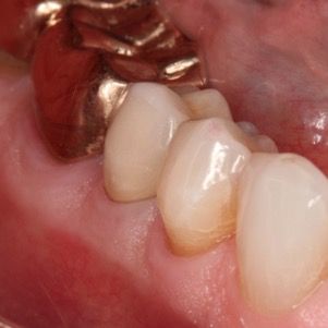 Dependent tall forest Fixed Prosthodontics – Tooth Preparation for posterior metal-ceramic crowns | Foundation for Oral-facial Rehabilitation Dependent tall forest Fixed Prosthodontics – Tooth Preparation for posterior metal-ceramic crowns | Foundation for Oral-facial Rehabilitation