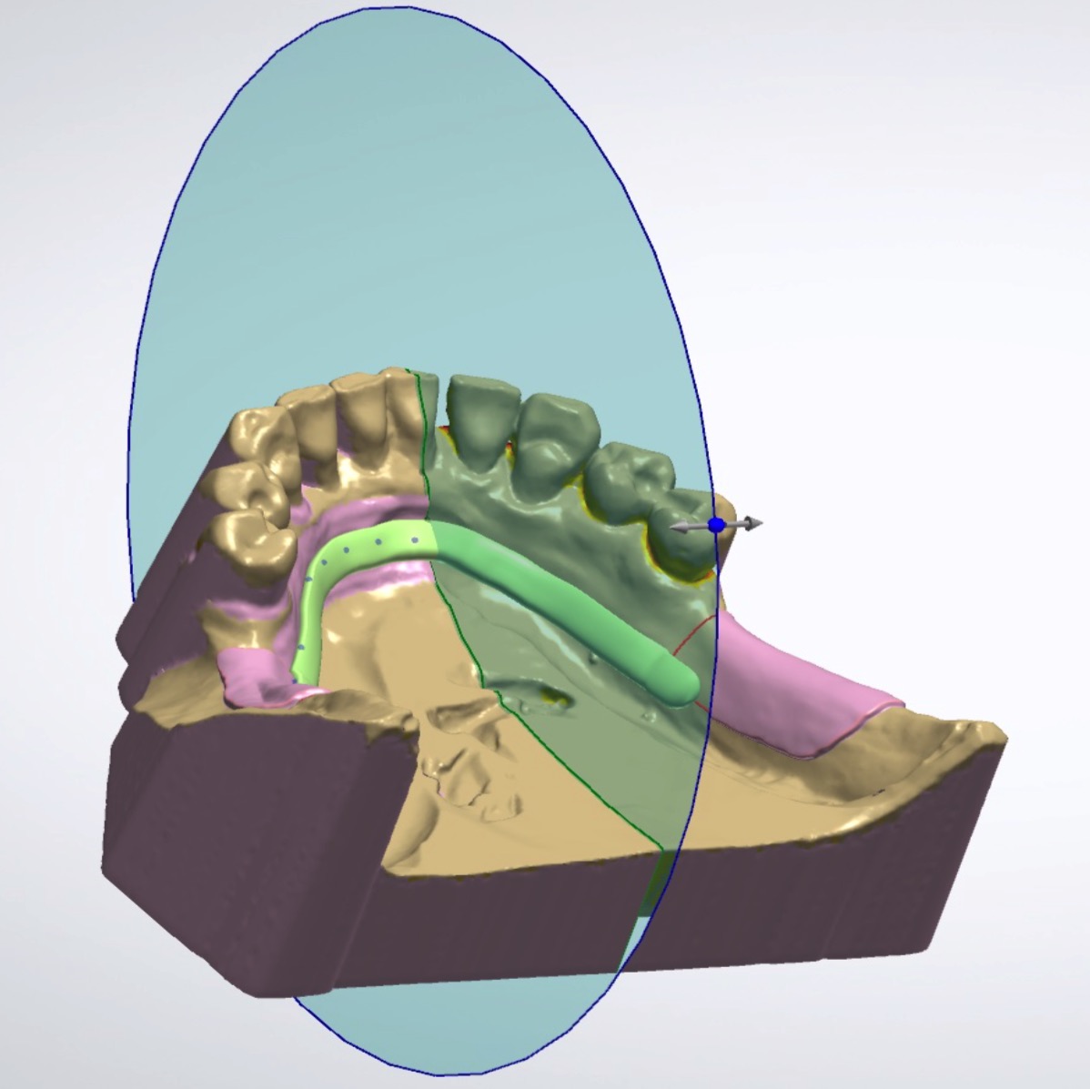 removable partial dentures foundation for oral facial removable partial denture design