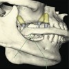 lateral excursion of tooth